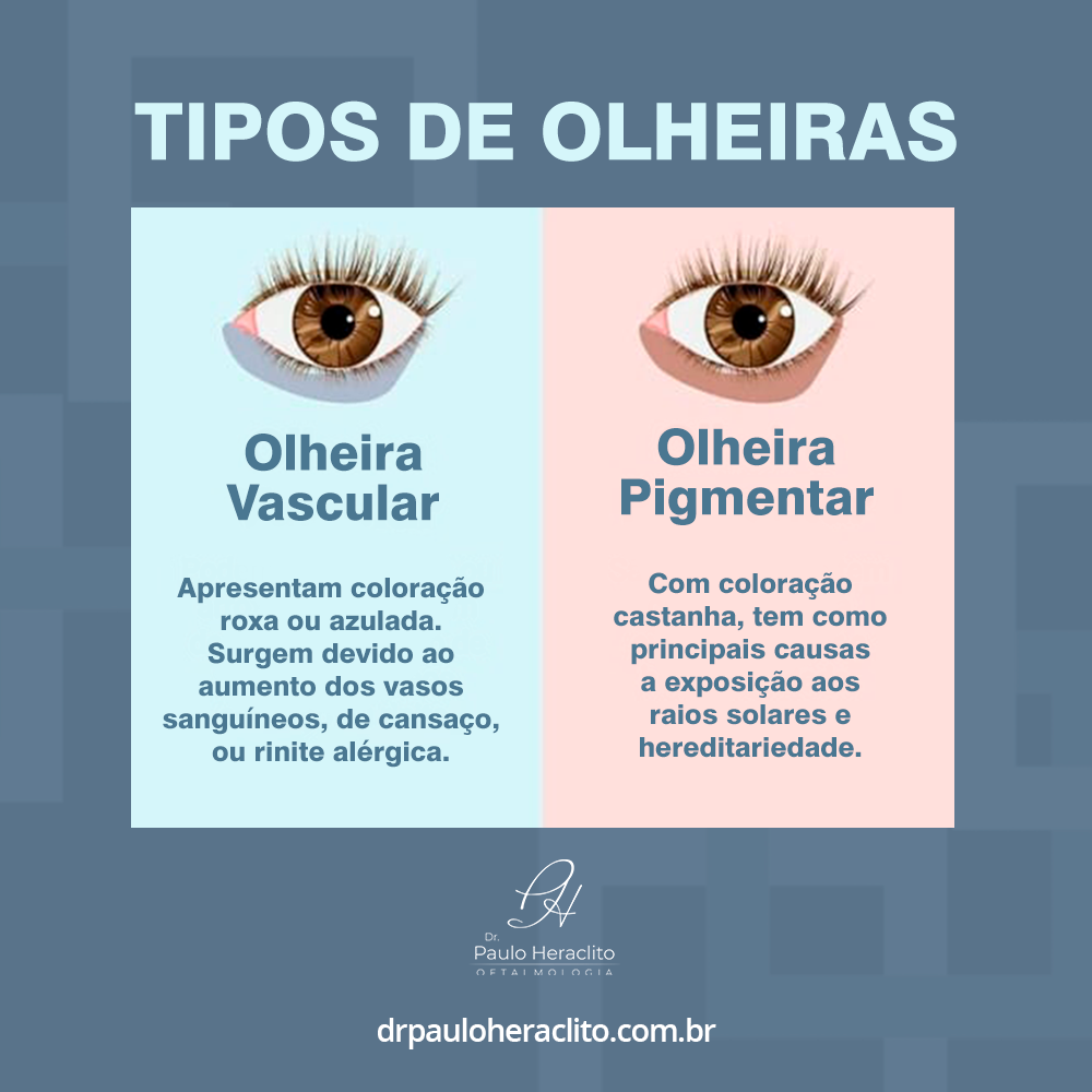 tipos de olheiras tipos de olheiras